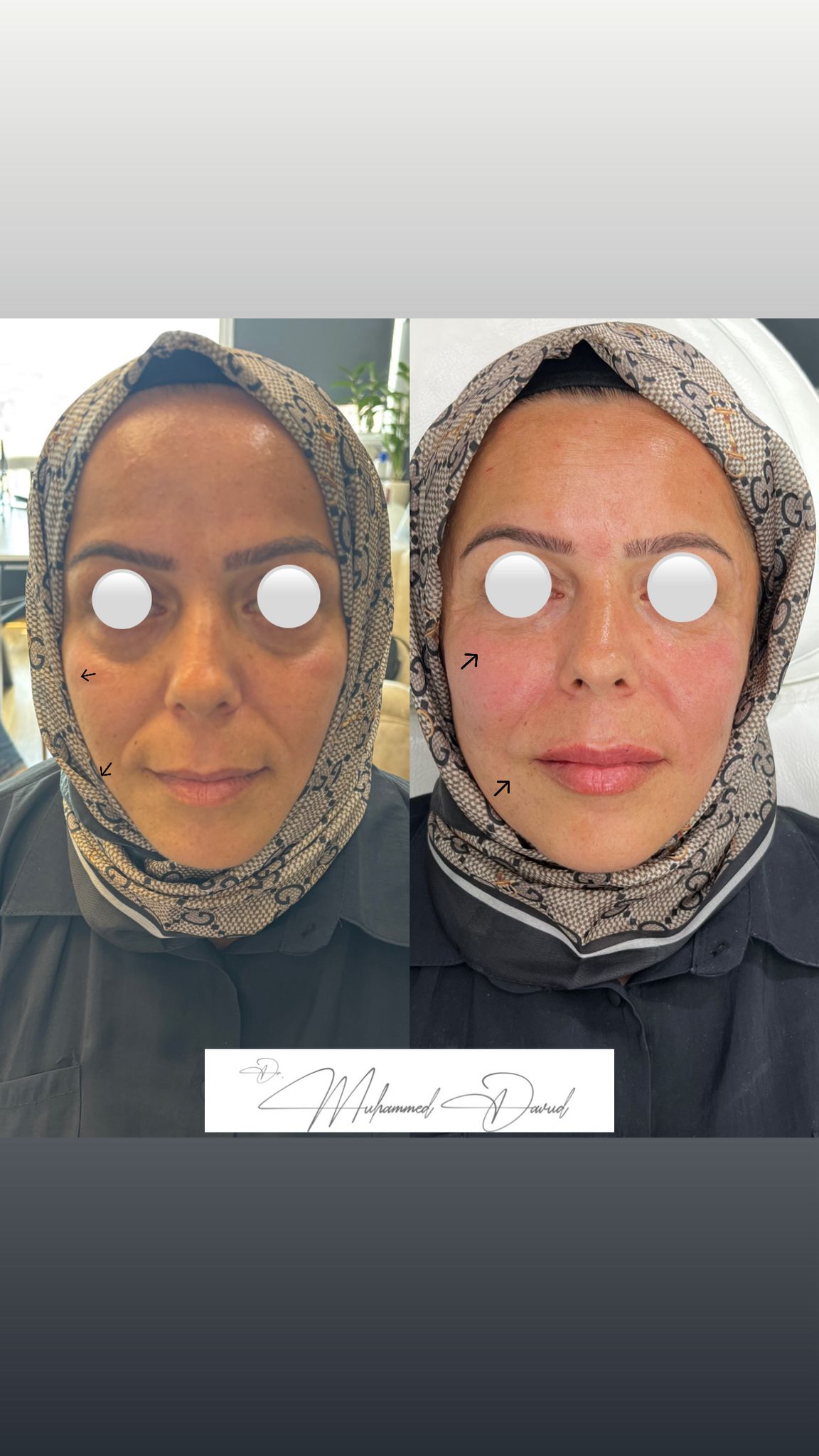 Facial contouring results